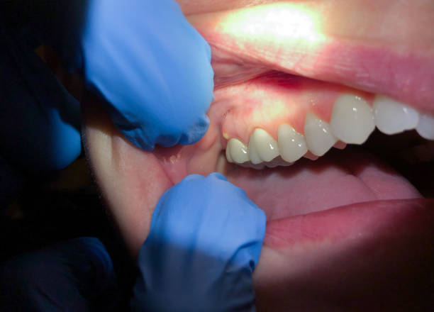 Best Emergency Dentist for Lost Fillings or Crowns in Krum, TX